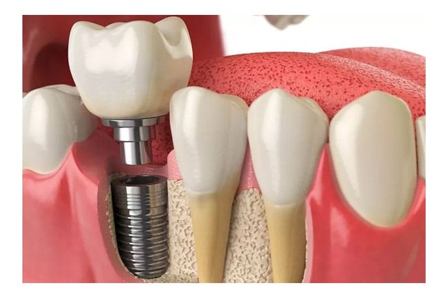 Implantes dentales