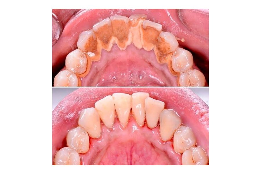 Limpieza dental