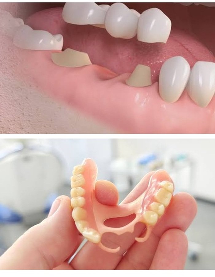 Prótesis dental